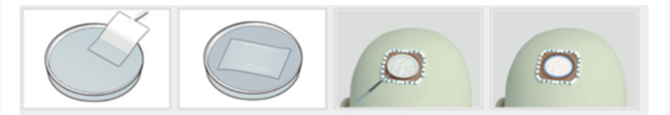 Preparación de NeoDura en solución salina y sutura relajada con separación de 2-3 mm para lograr un cierre dural hermético.